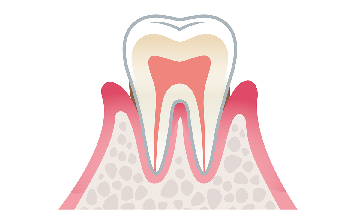 歯周炎（軽度）