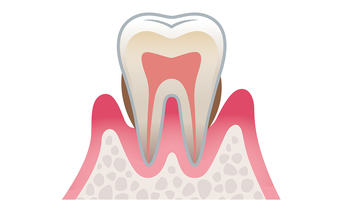 歯周炎（中度）