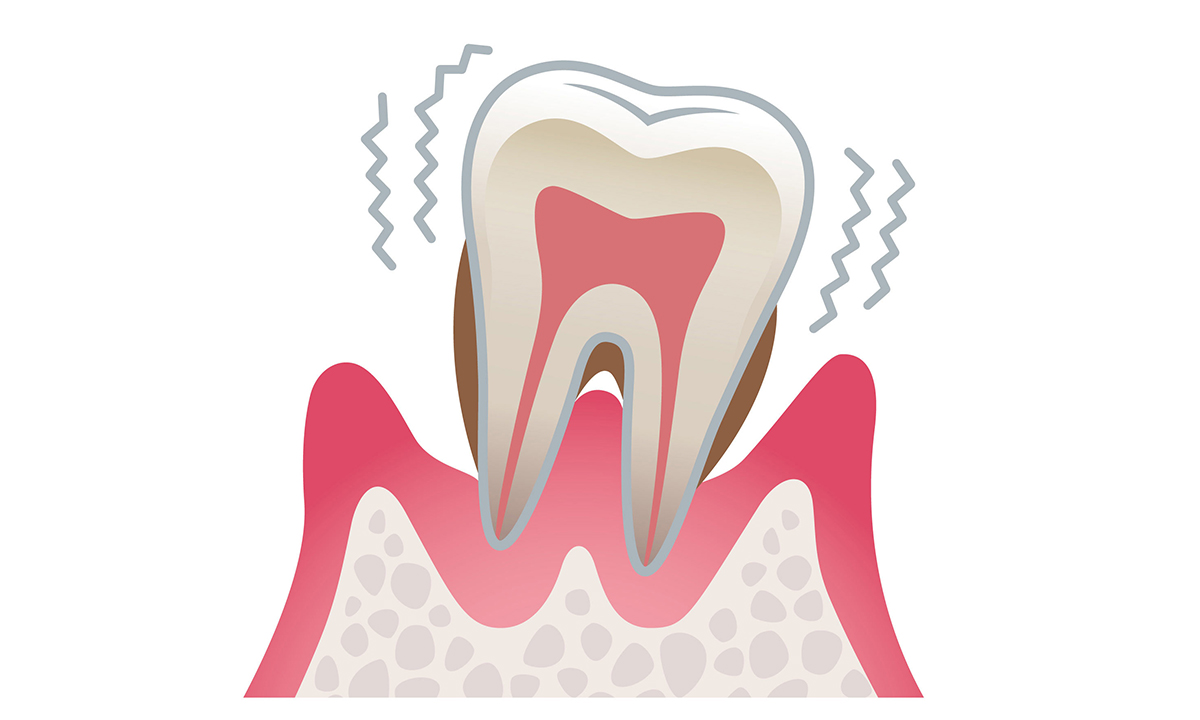 歯周炎（重度）