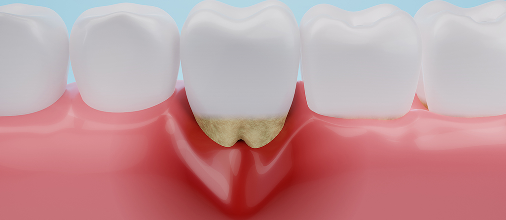 歯周病について